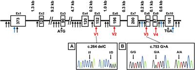 AKR1A1 Variant Associated With Schizophrenia Causes Exon Skipping, Leading to Loss of Enzymatic Activity